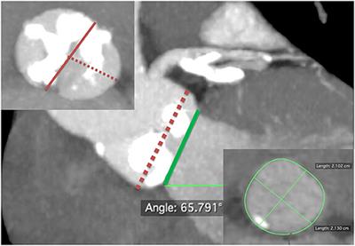 The Presence of Calcified Raphe Is an Independent Predictor of Adverse Long-Term Clinical Outcomes in Patients With Bicuspid Aortic Stenosis Undergoing Transcatheter Aortic Valve Replacement